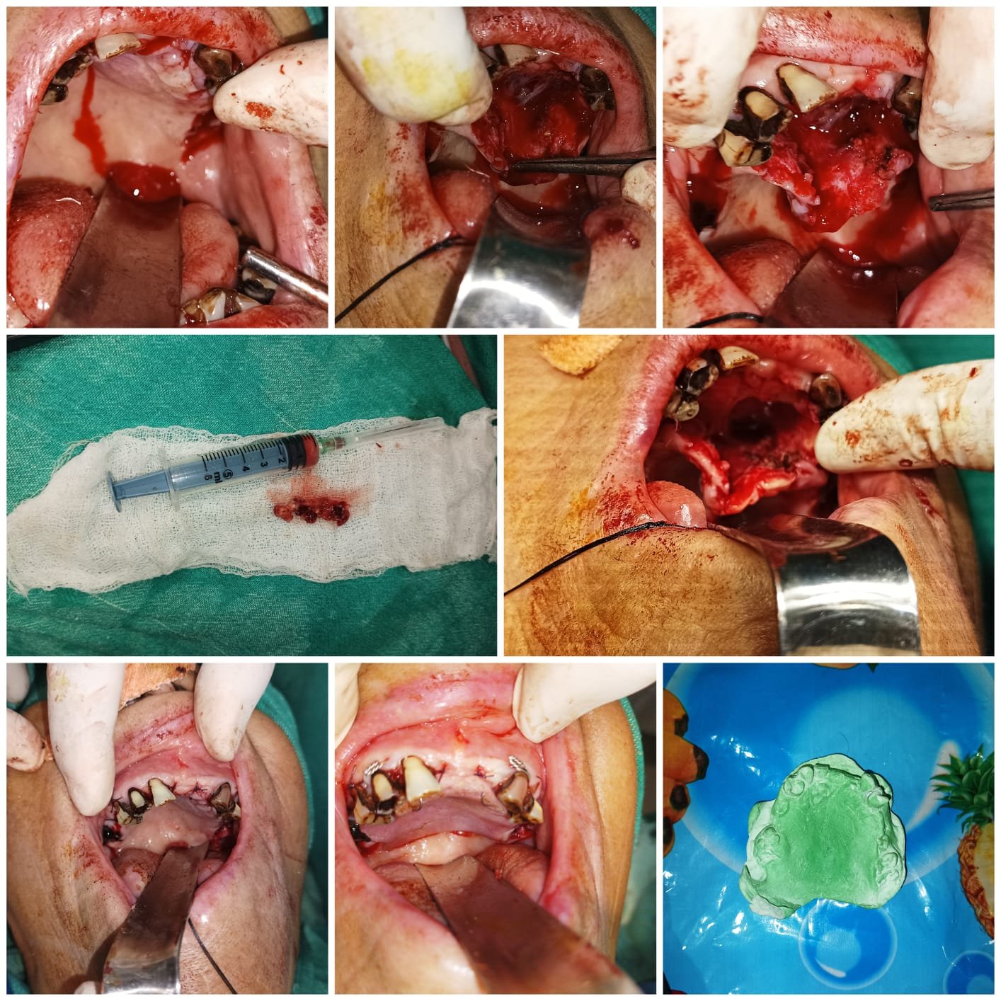 palatal cyst repair